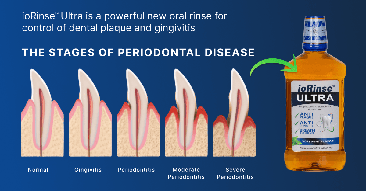 Study Reveals Brushing and Rinsing Superior to Brushing and Flossing in Preventing Periodontal Disease