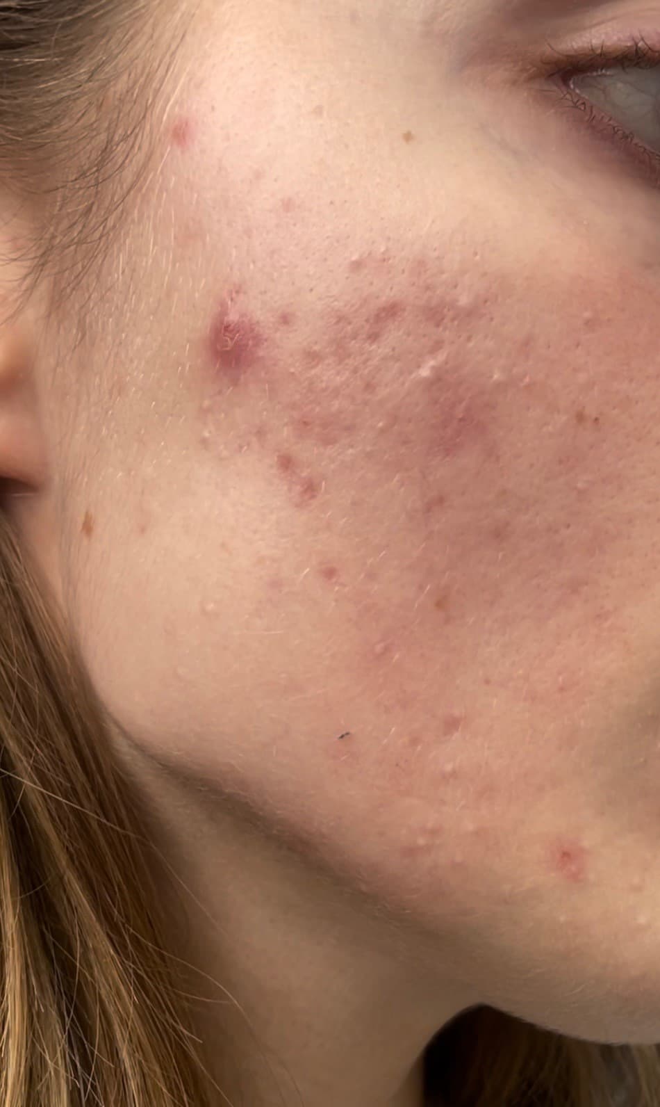 XVesuvius Wins Men's Health 2025 Grooming Award for Best Acne Product