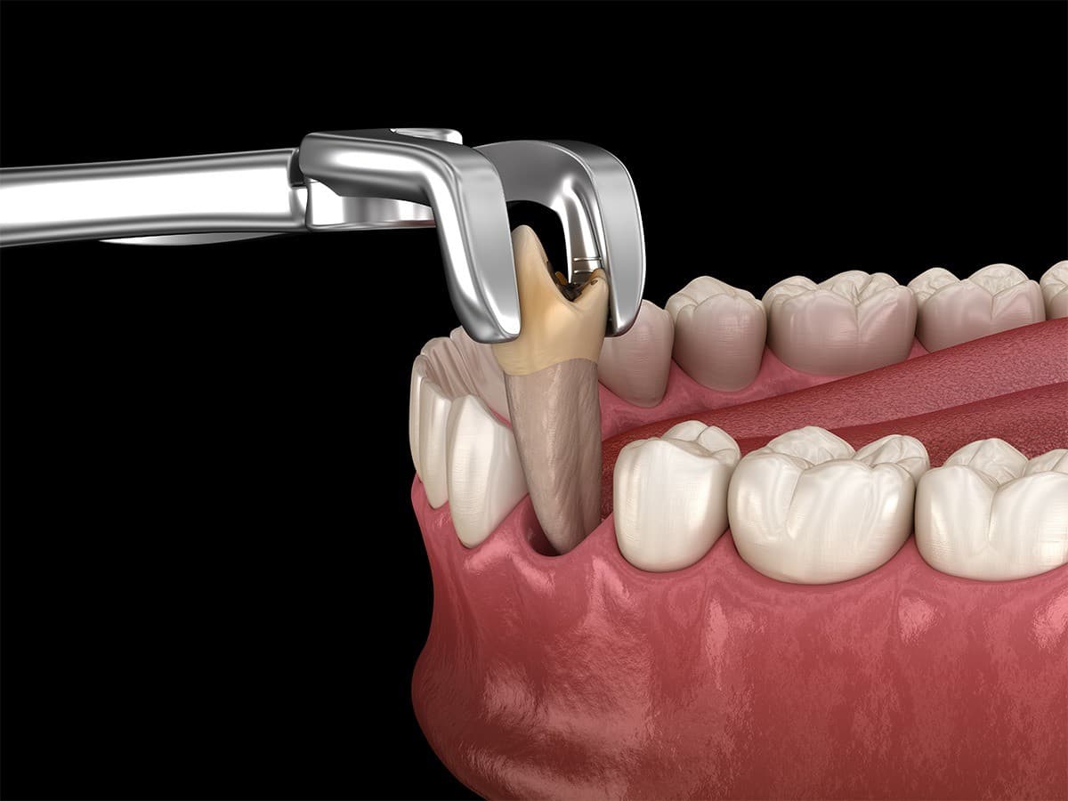 Sioux Falls Oral Surgery Practice Publishes Extraction Guide to Ease Patient Anxiety