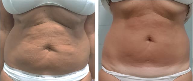 Ovation Med Spa Launches Advanced BodyEstiq™ Onda Coolwaves® Technology for Enhanced Body Contouring
