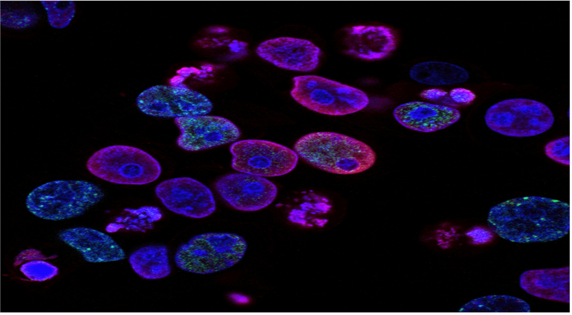 Promising Prostate Cancer Treatment Combo Targets Hard-to-Treat Metastatic Tumors