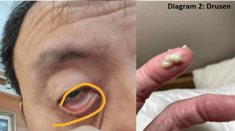 Lorati Introduces Nano-Grade Eye Drops for Age-Related Macular Degeneration Treatment